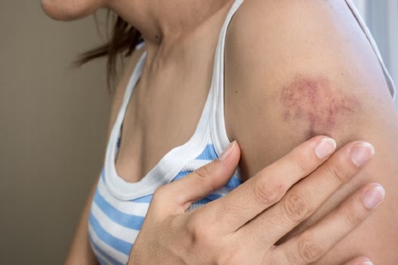 hematomas.jpg