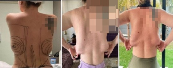 Influencer procedimento